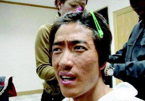 满脸痘坑的女明星,揭秘满脸痘坑女明星的美丽蜕变之路